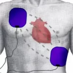 How to place AED Pads on a body